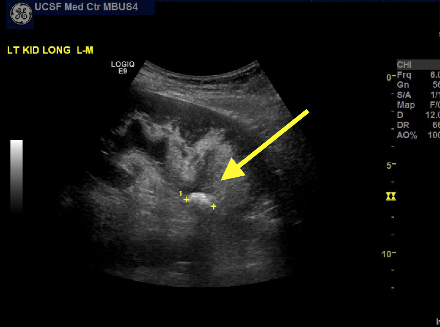 ultrasound-guided-pcnl-innovation-comes-with-patient-safety-and
